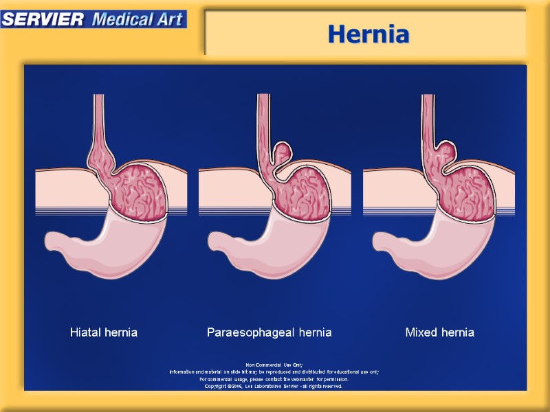 Hernia Hiatal hernia Mixed hernia Paraesophageal hernia